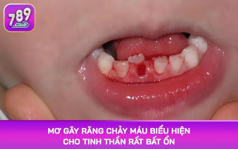 Mơ gãy răng chảy máu biểu hiện cho tinh thần rất bất ổn